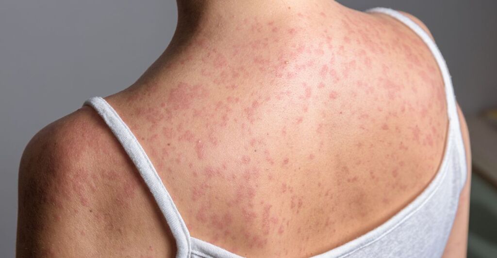 Una ragazza con il morbillo