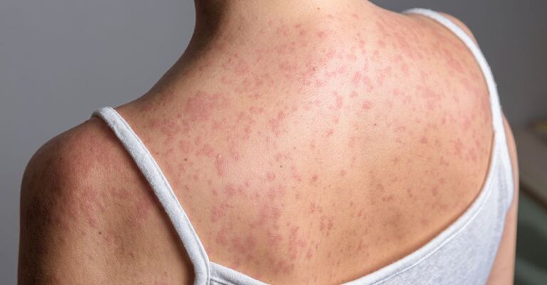 Una ragazza con il morbillo