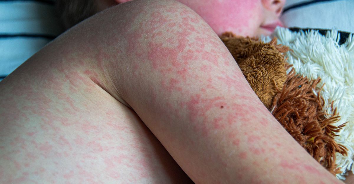 Un bambino con il morbillo