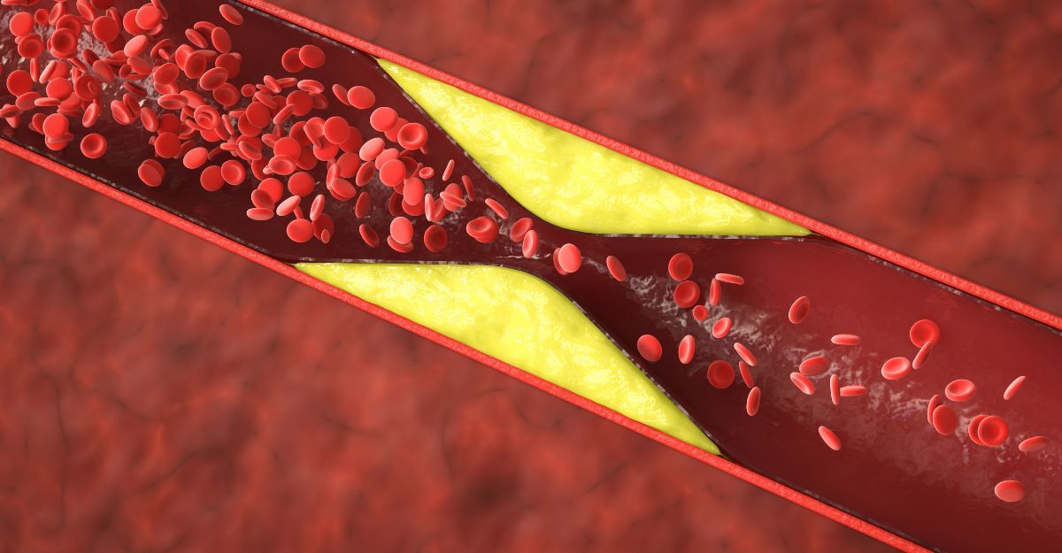 Rappresentazione 3D del flusso sanguigno all'interno di un'arteria parzialmente ostruita da placche di colesterolo giallo.