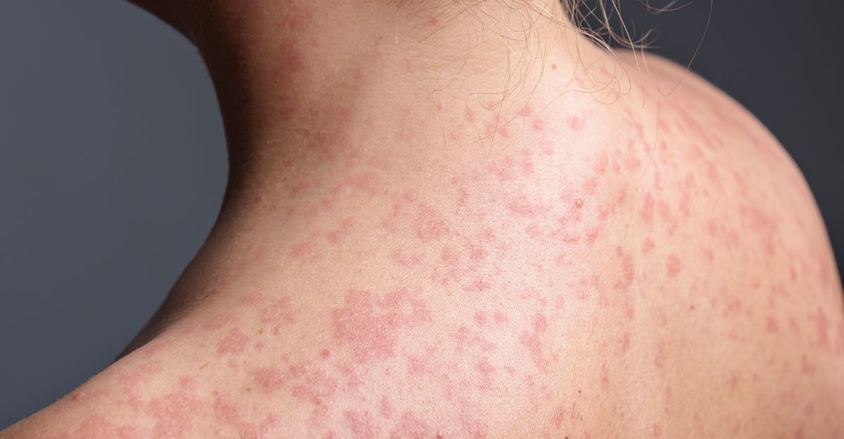 La pelle di un paziente con morbillo