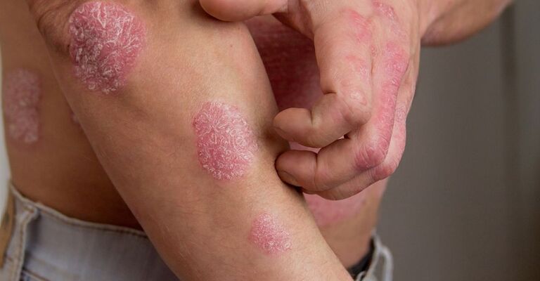 Una persona con la psoriasi