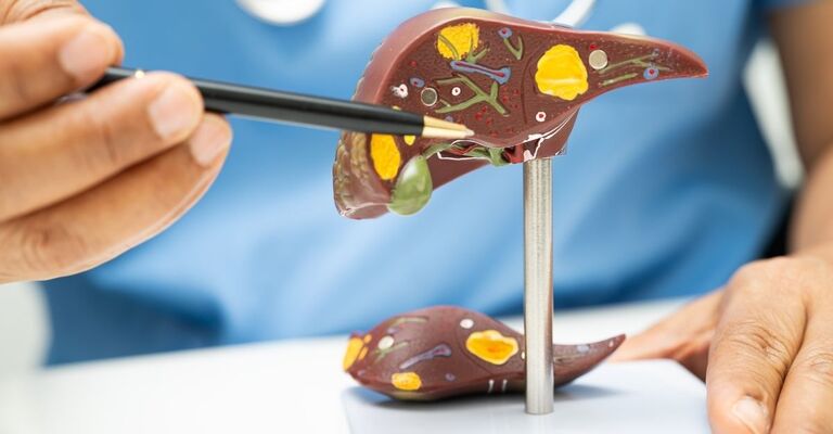 Un medico in camice blu indica con una penna un modello anatomico del fegato che mostra depositi di grasso al suo interno
