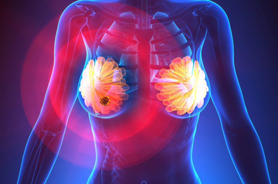 Un test per diagnosticare il tumore al seno con cinque anni di anticipo