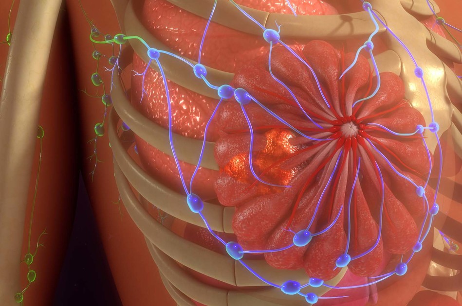 Tumore al Seno Triplo Negativo: perché è tra i più Aggressivi | Pazienti.it
