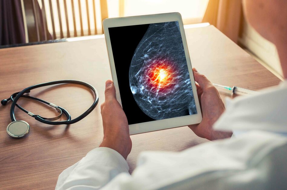 Chemioterapia In Pastiglie Per Tumore Al Seno Forum Chemioterapia per la Cura del Tumore al Seno: quando Non è Necessaria