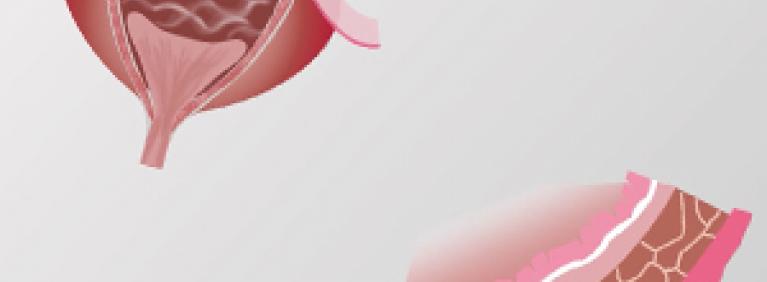 Bladder Cancer Fact Sheet