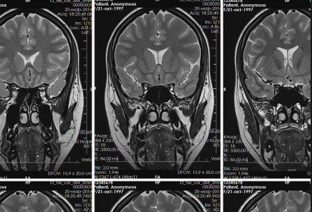 Что выявляет обзорная МРТ головного мозга