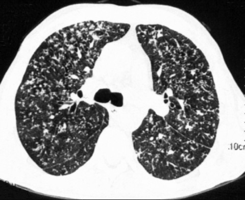 КТ при туберкулезе легких