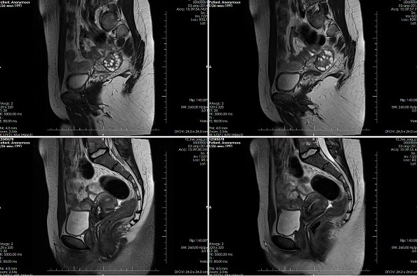 МРТ малого таза: расшифровка результатов