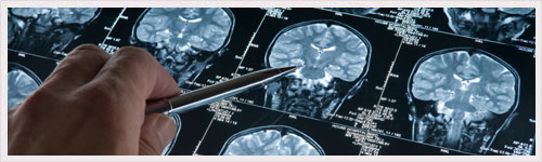 Maladie d’Alzheimer : mise en évidence d’un processus de l’atrophie hippocampique