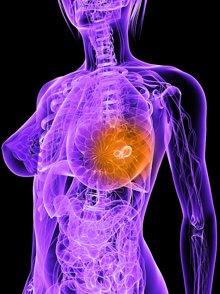récidive du cancer du sein