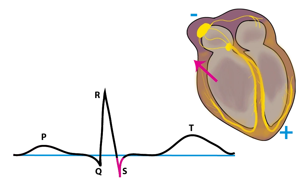 EKG, EKG S-Zacke, StudySmarter