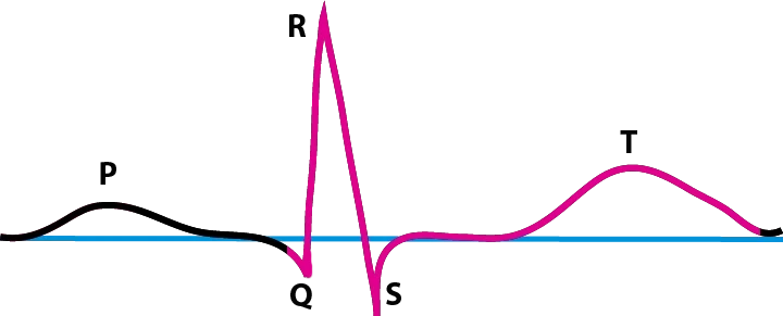 EKG, QT-Zeit, StudySmarter