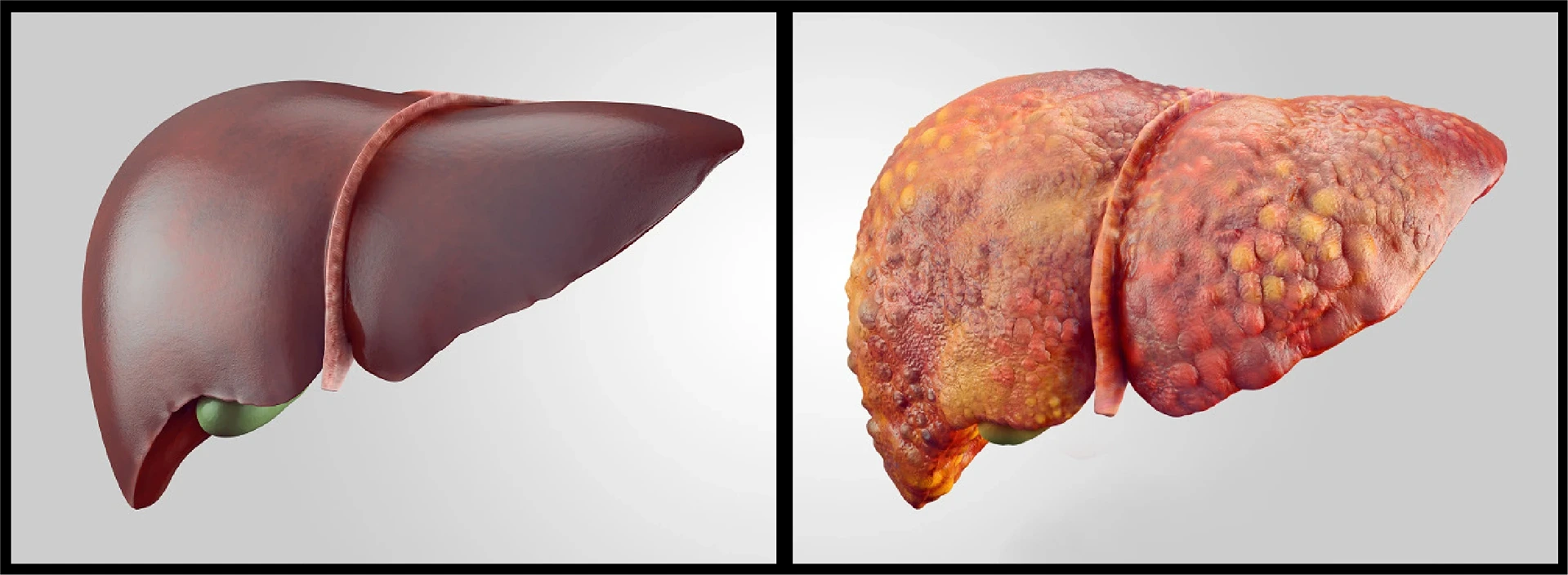 Hepatitis Hepatitis Symptome Leberzirrhose StudySmarter