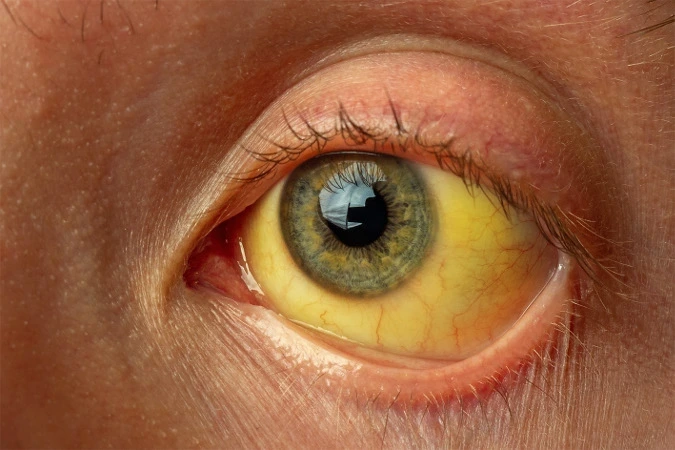 Hepatitis Hepatitis Symptome Gelbsucht StudySmarter