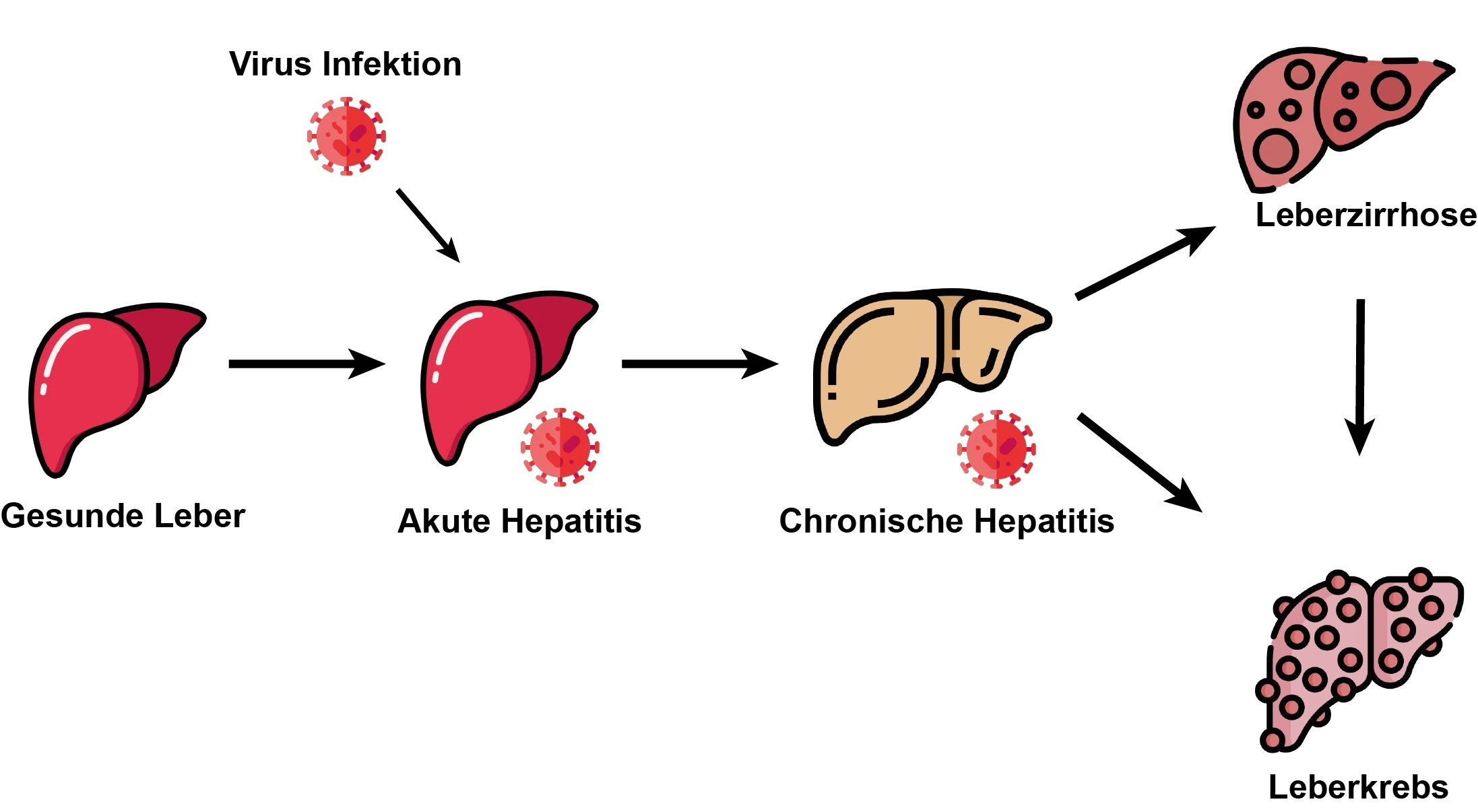 Hepatitis Hepatitis Symptome Verlauf StudySmarter