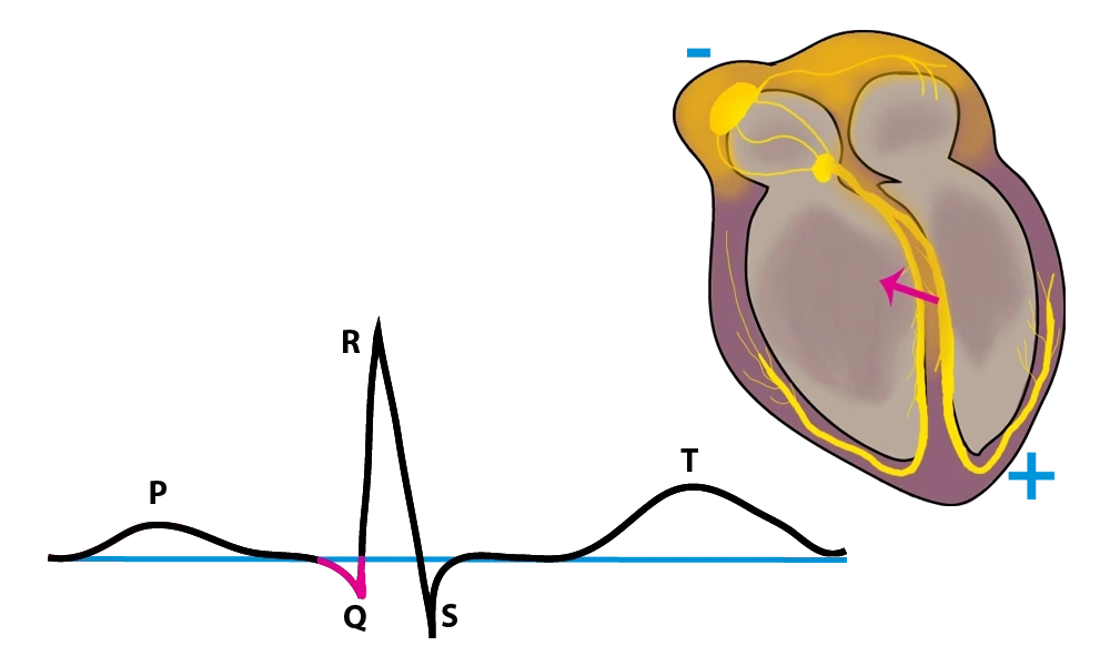 EKG, EKG Q-Zacke, StudySmarter