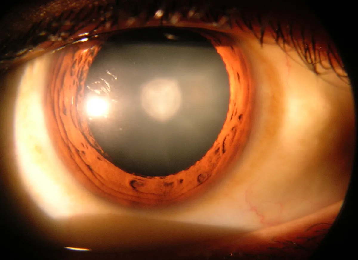 Les défauts de la vision et leur correction, Gros plan sur un œil atteint de cataracte, StudySmarter