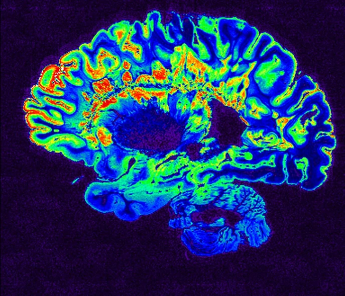 Aimants cerveau IRM StudySmarter