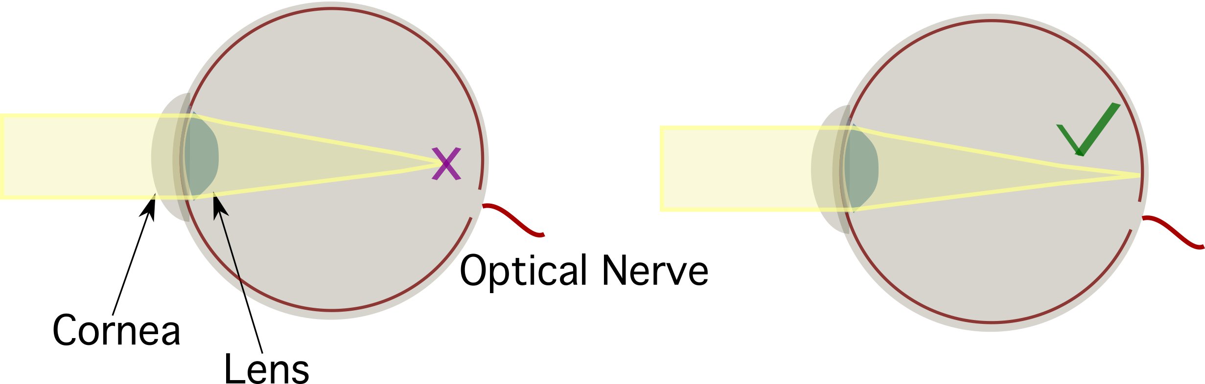 Physique médicale. Myopie. La vue. Optique. StudySmarter