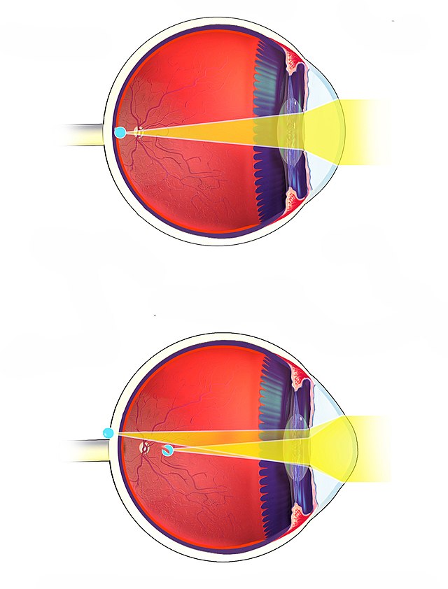 Defectos de la visión Defectos de la visión y su corrección astigmatismo StudySmarter