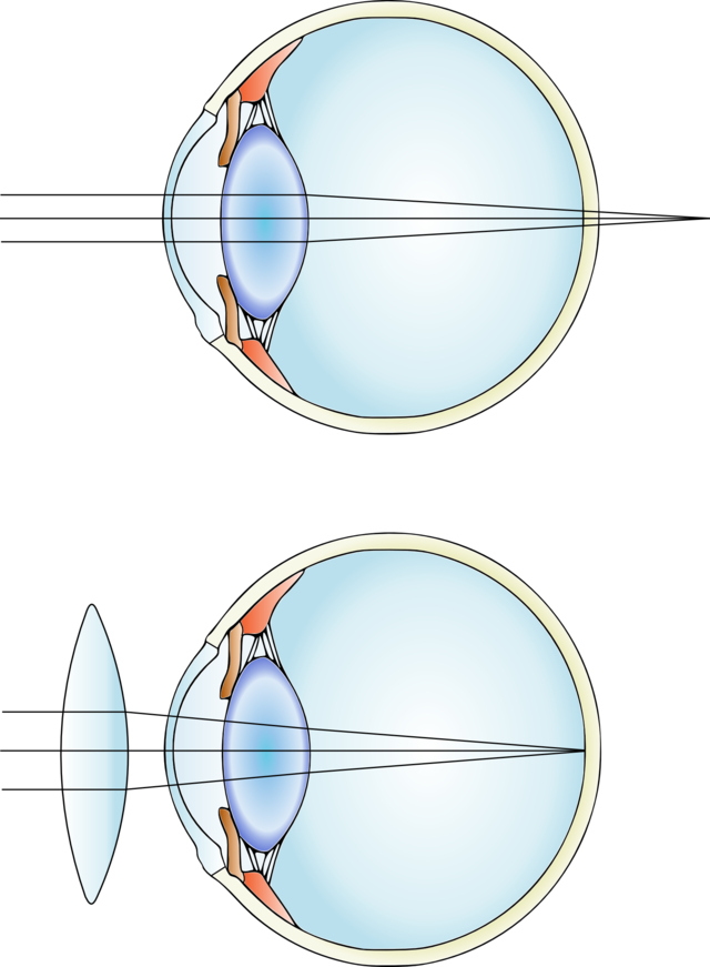 Les anomalies de la vision, œil hypermétrope, StudySmarter