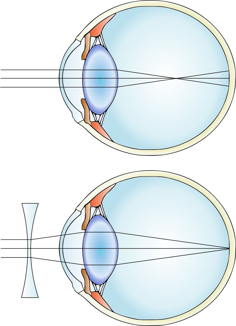 Les anomalies de la vision, œil myope, StudySmarter