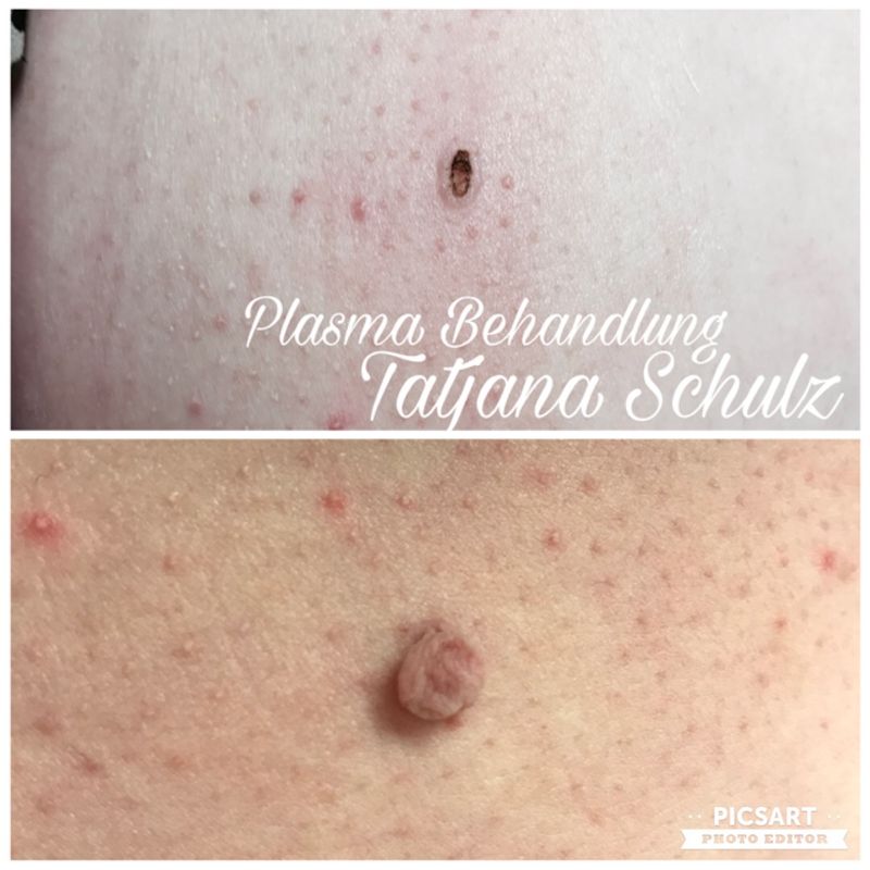 Plasma Behandlung. Stielwarze Entfernung.