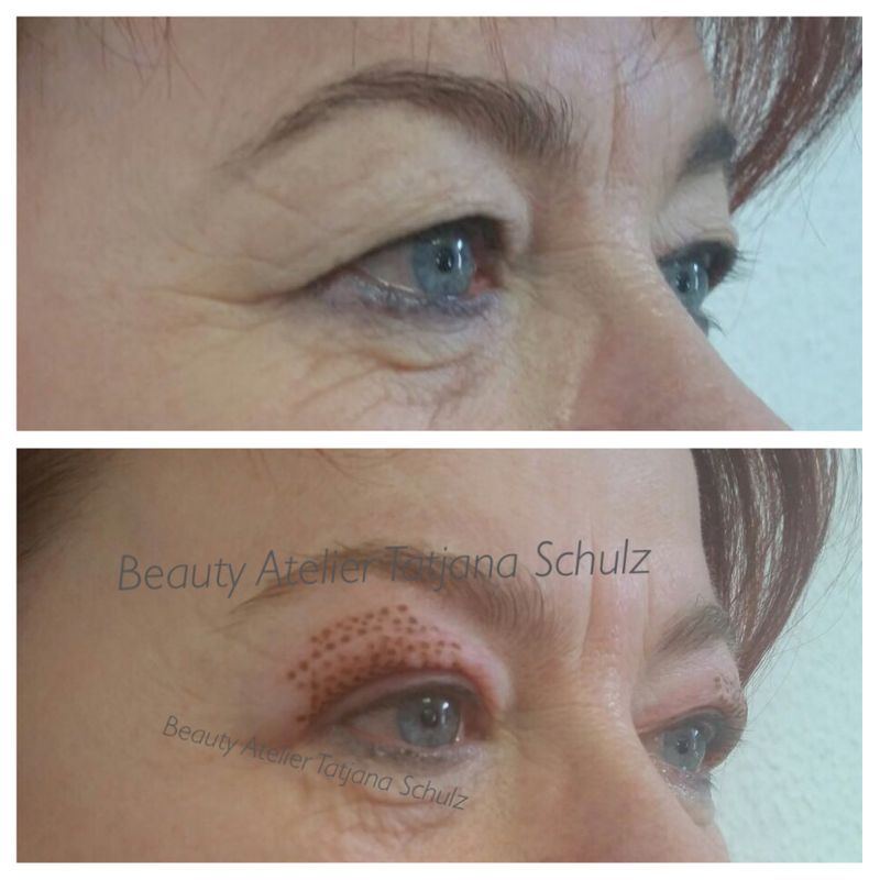 Plasma Behandlung, sofort nach der Behandlung