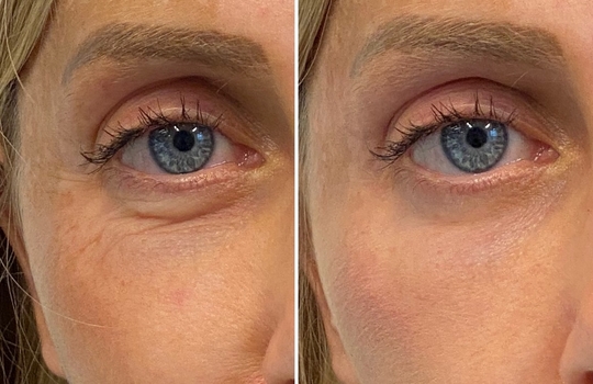 bridal botox - the full low down  inspiration photo 2