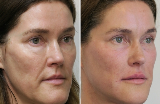 bridal botox - the full low down  inspiration photo 1