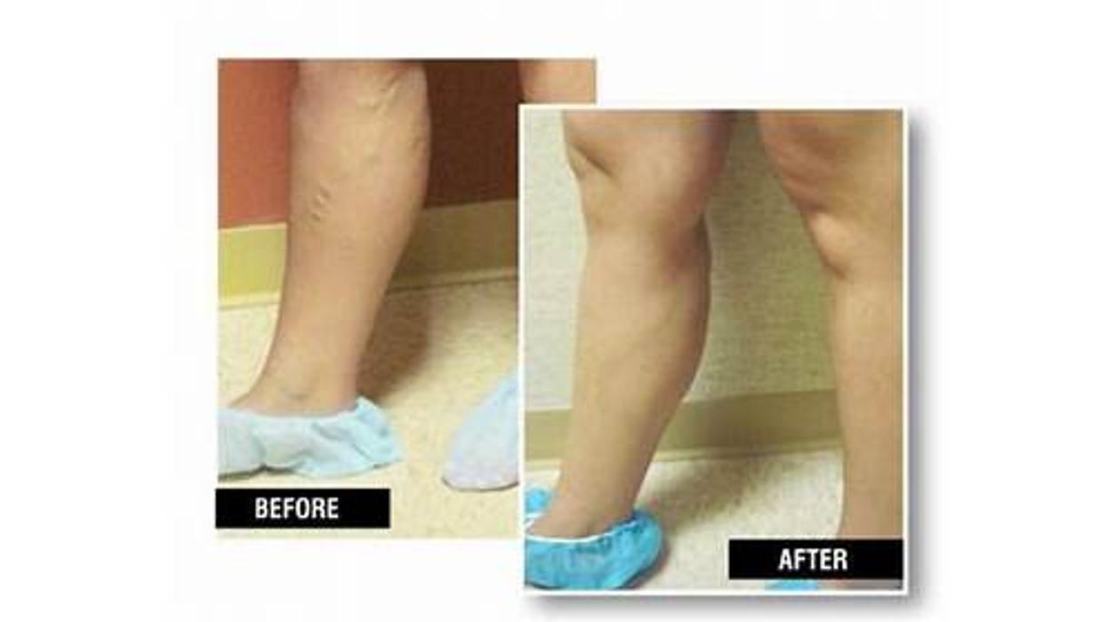 USA Vein Clinics - Suffern, NY