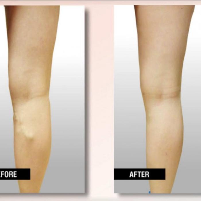 USA Vein Clinics - Suffern, NY