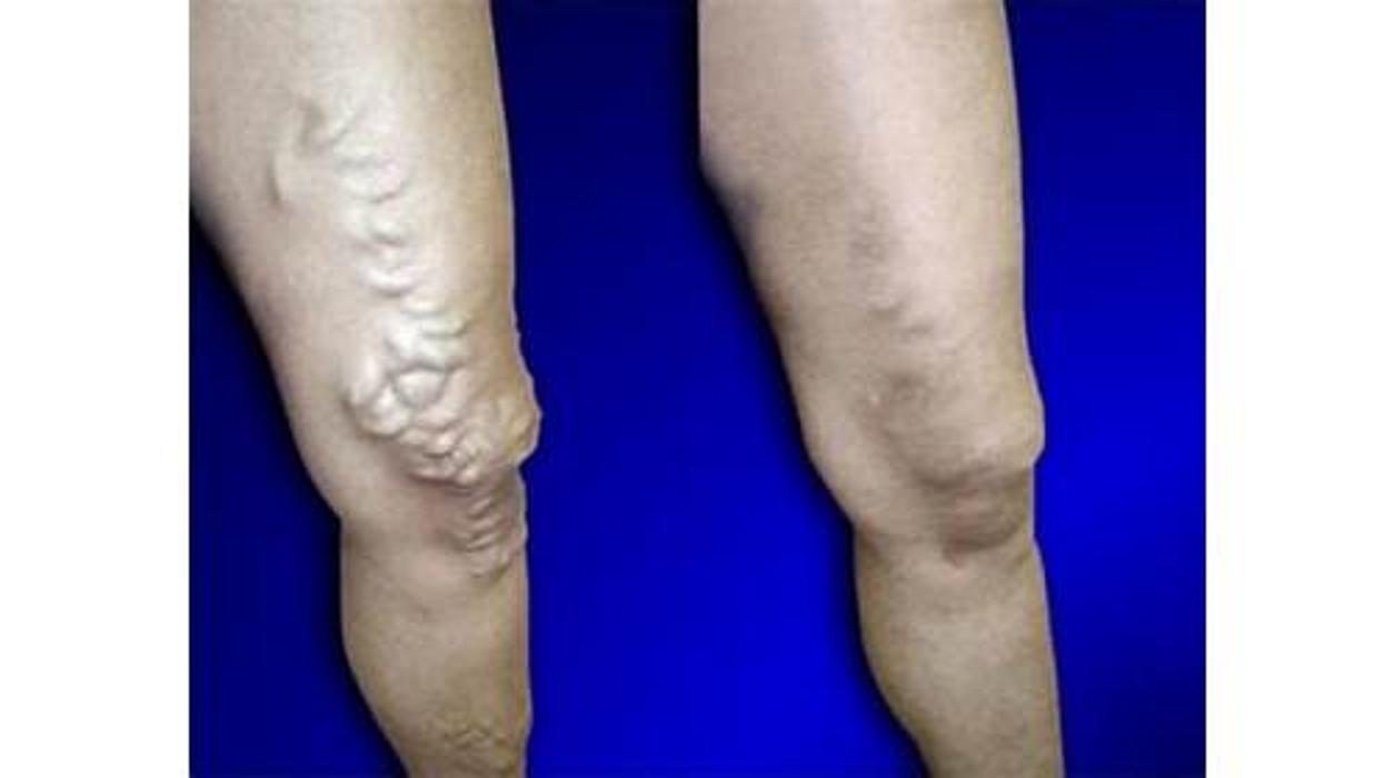 USA Vein Clinics - Suffern, NY