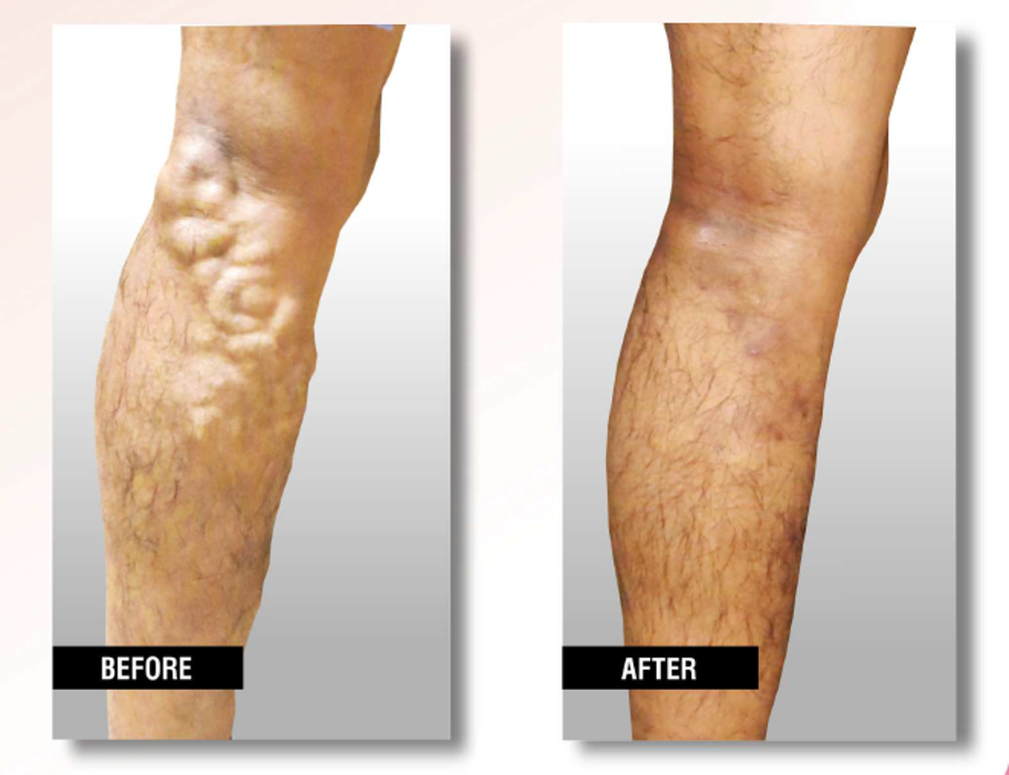 USA Vein Clinics - Suffern, NY
