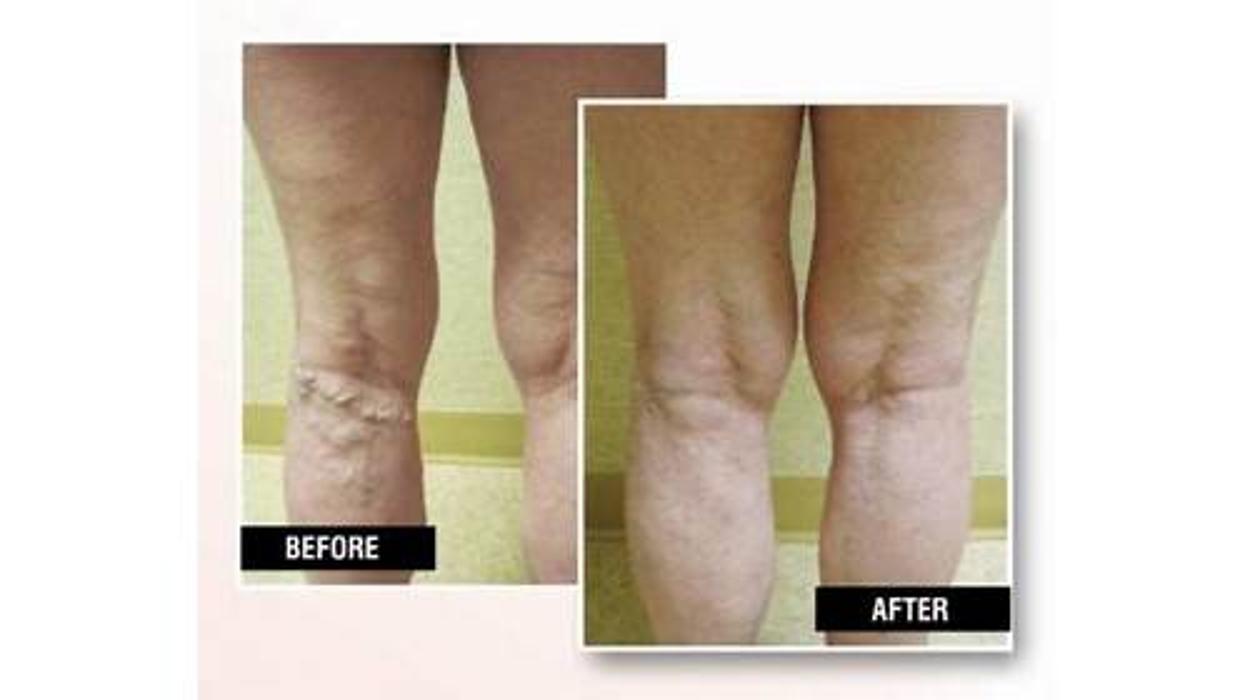 USA Vein Clinics - Suffern, NY