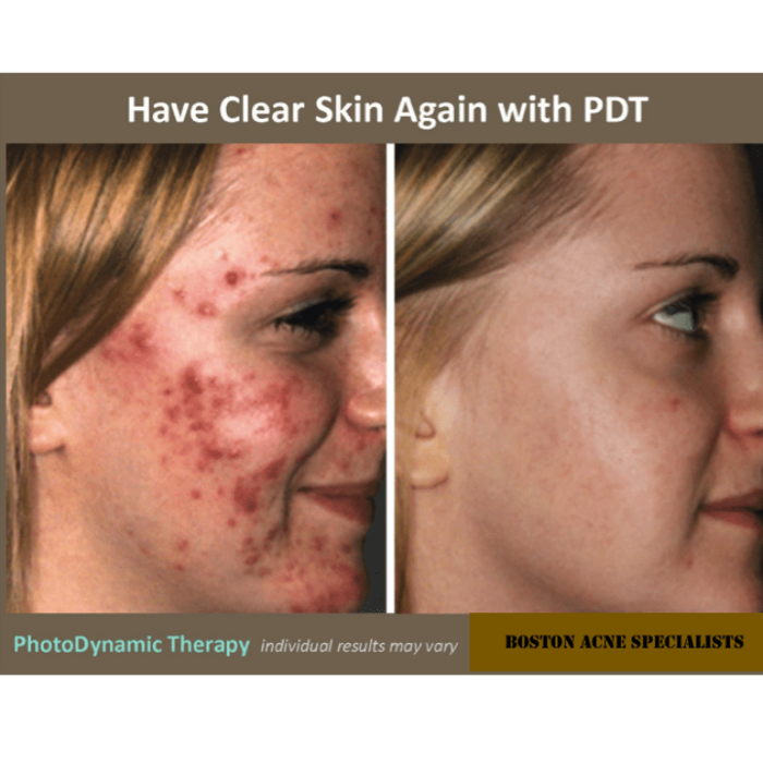 Boston Acne Specialists - Cambridge, MA