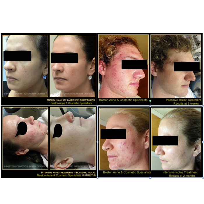Boston Acne Specialists - Cambridge, MA