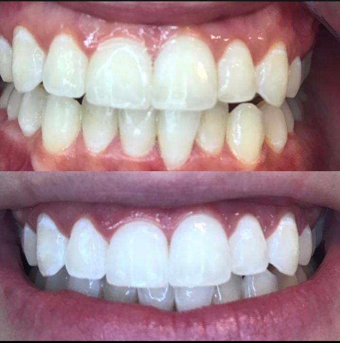 Organically White Teeth Whitening - Albuquerque, NM