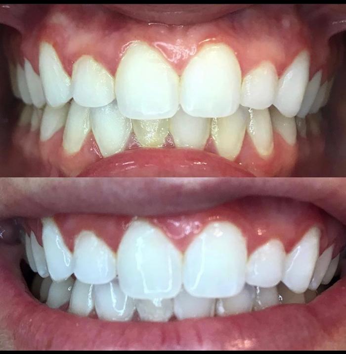 Organically White Teeth Whitening - Albuquerque, NM