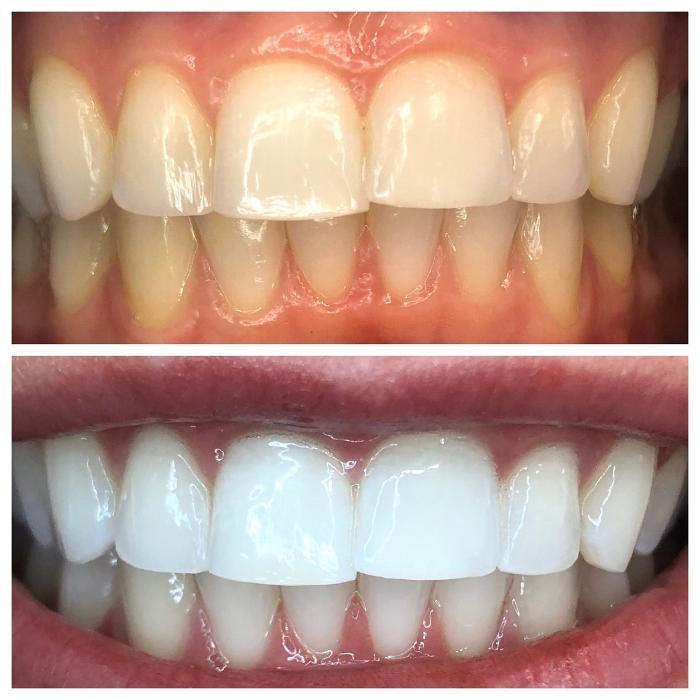 Organically White Teeth Whitening - Albuquerque, NM