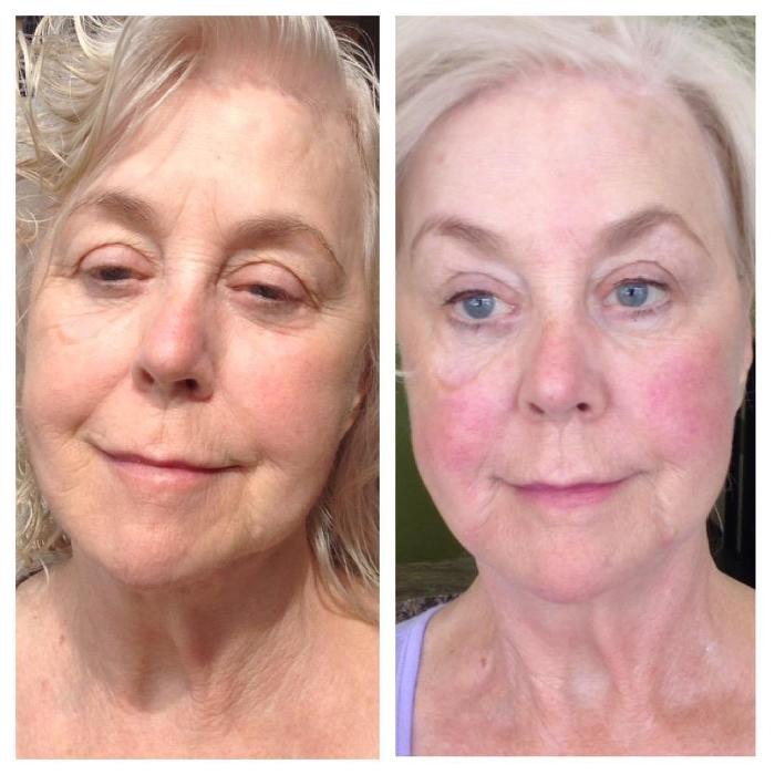 Body Lyft System - Carmel, IN