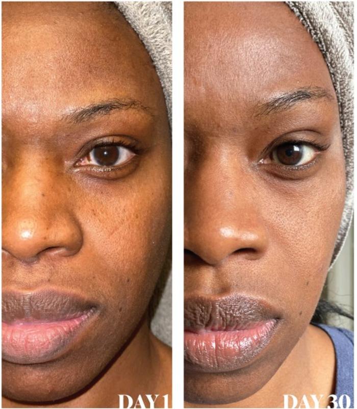 Body Lyft System - Carmel, IN