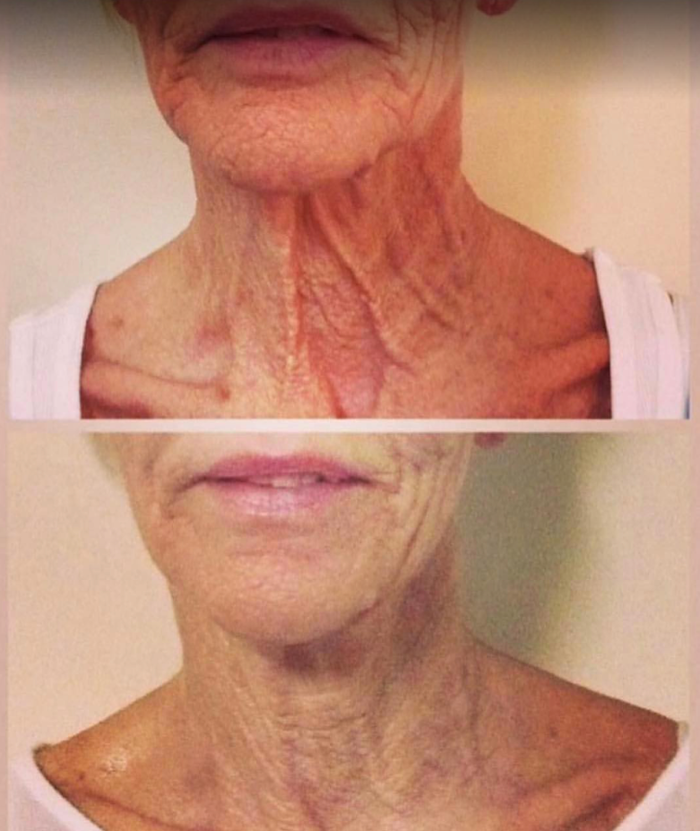 Body Lyft System - Carmel, IN