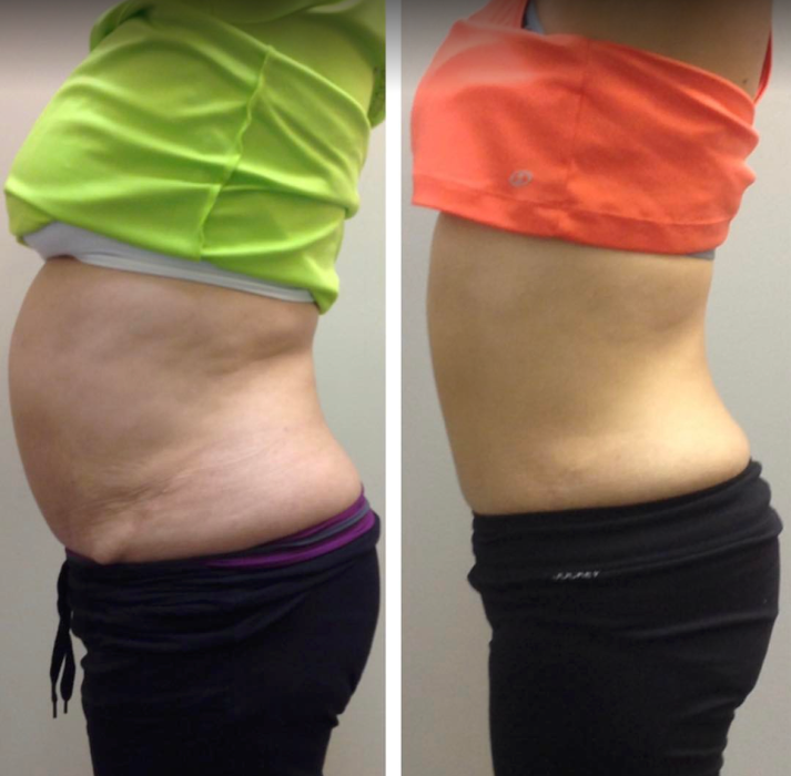 Body Lyft System - Carmel, IN