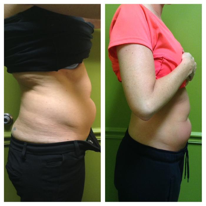 Body Lyft System - Carmel, IN