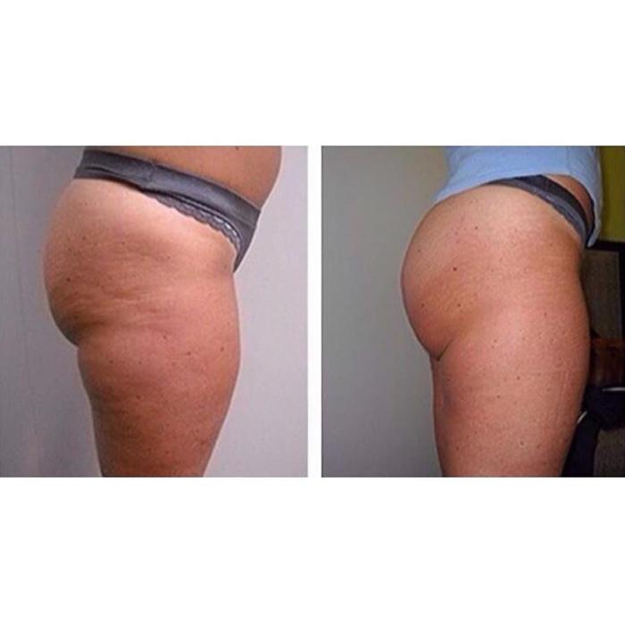 Body Lyft System - Carmel, IN