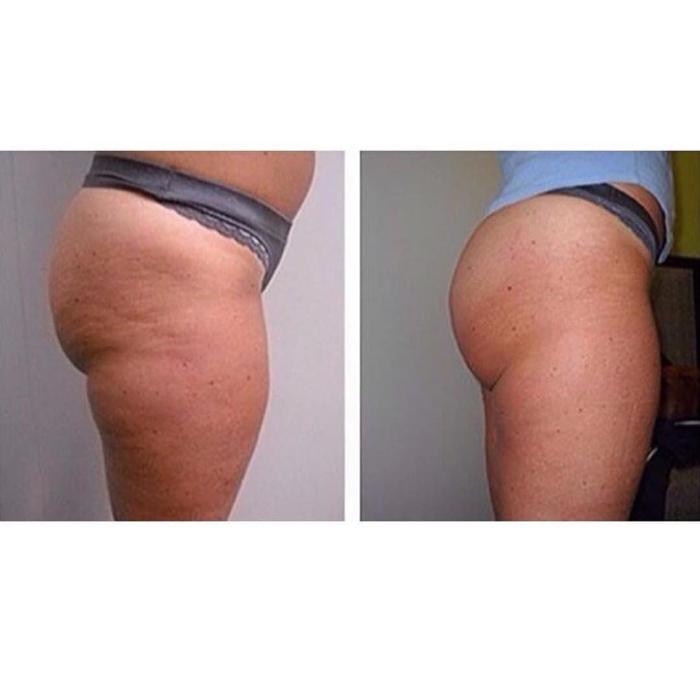 Body Lyft System - Carmel, IN