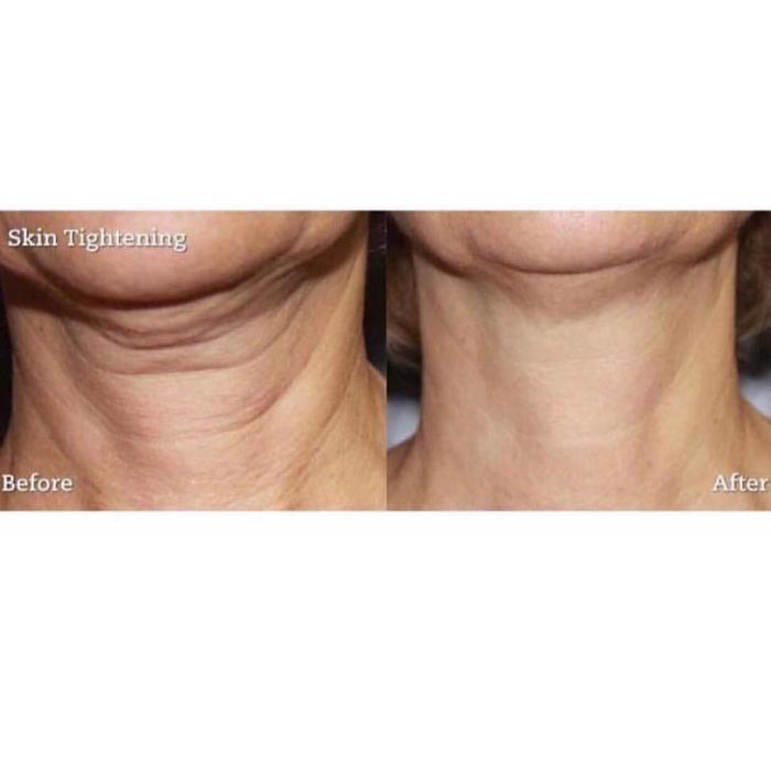 Body Lyft System - Carmel, IN